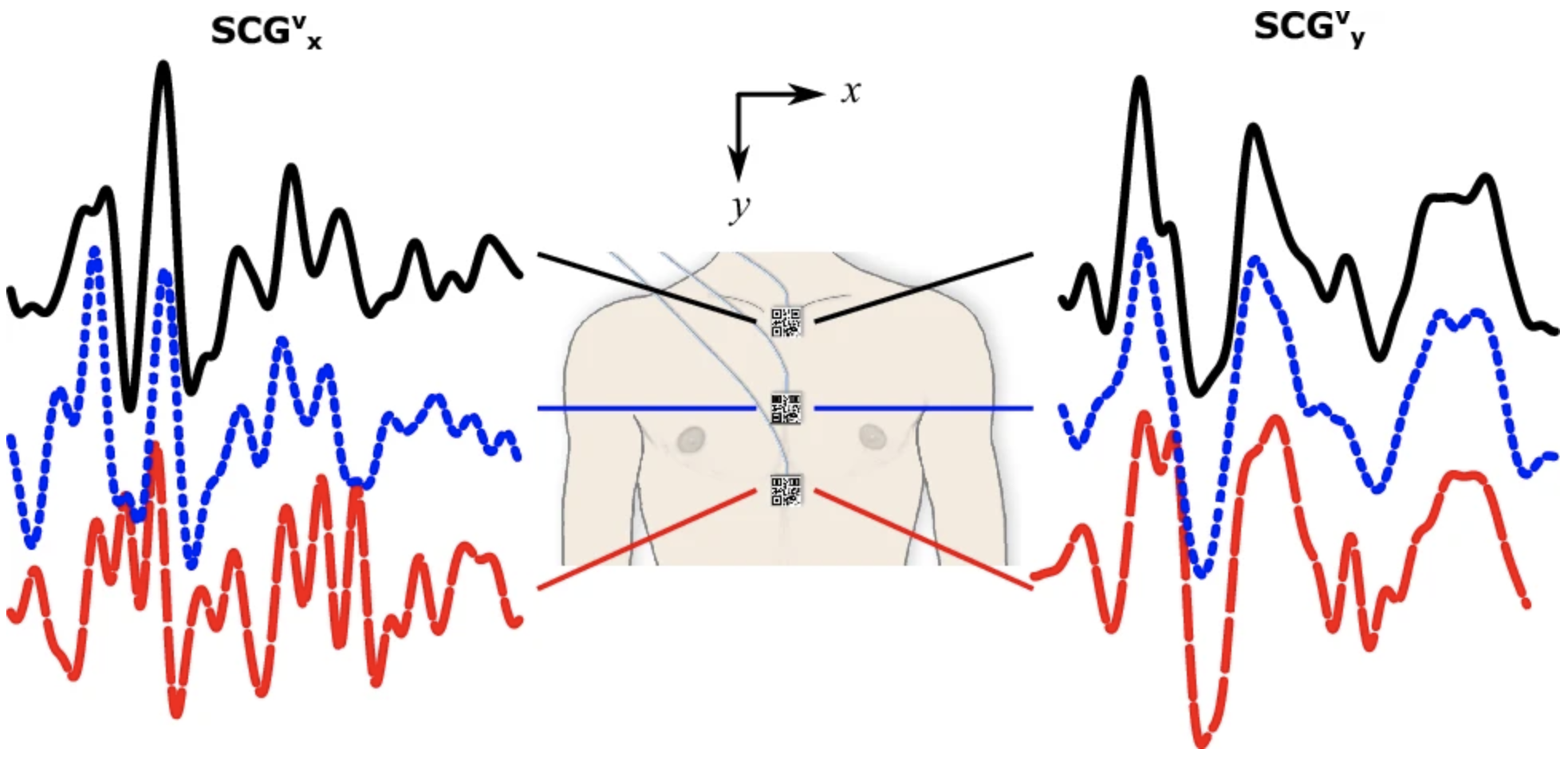 Non-contact Heart Vibration Measurement Using Computer Vision-based Seismocardiography